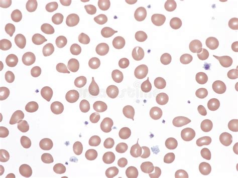 dacrocytes|Tear Cells (Dacrocytes, Teardrops) – A Laboratory Guide to .